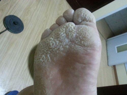 国产脚底角质去除视频,国产去角质视频教程大揭秘