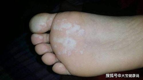 国产脚底角质去除视频,国产去角质视频教程大揭秘  第2张